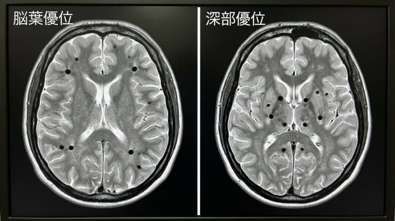 深部型と脳葉型の脳微小出血の分布を比較する教育用図